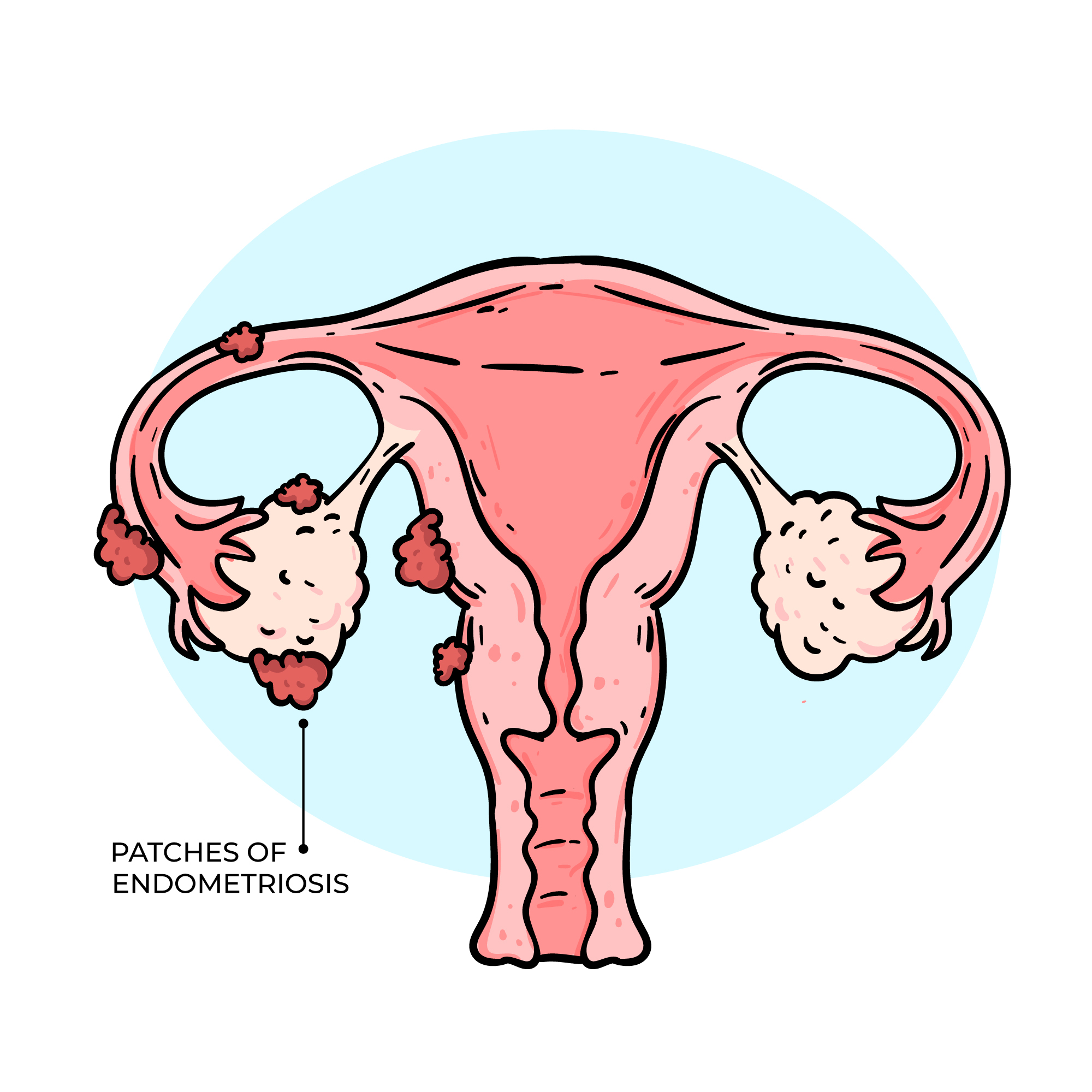 Kanker Endometrium (Rahim) - OPSI Medis