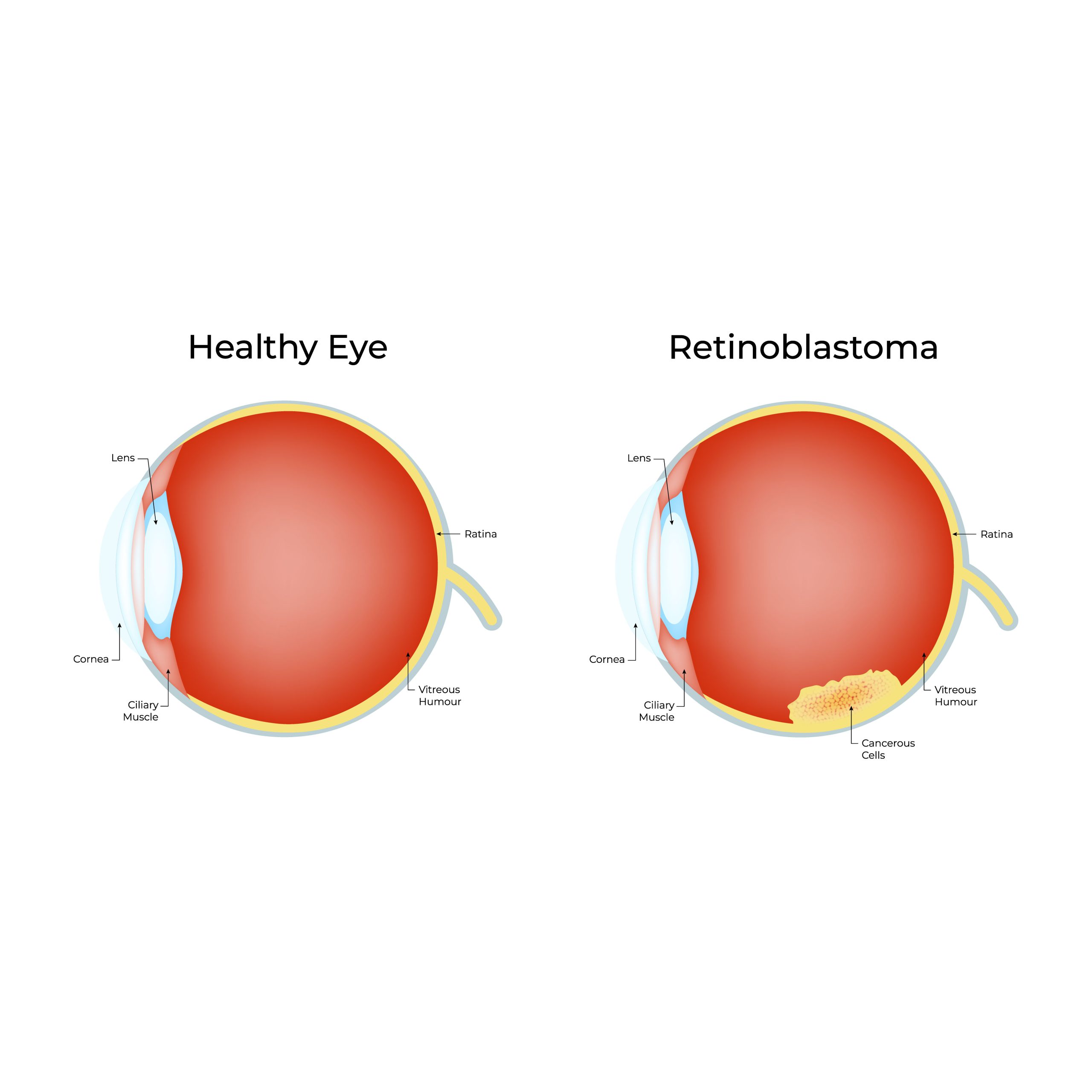 Kanker Mata - OPSI Medis
