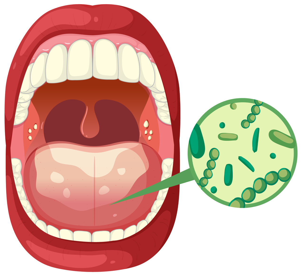 Leukoplakia & Lesi Mulut Pra-Kanker - OPSI Medis