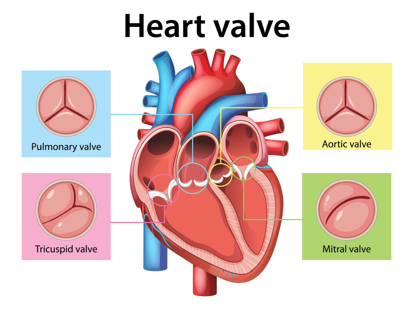 Prosedur TAVI/TAVR (katup aorta tanpa bedah)
