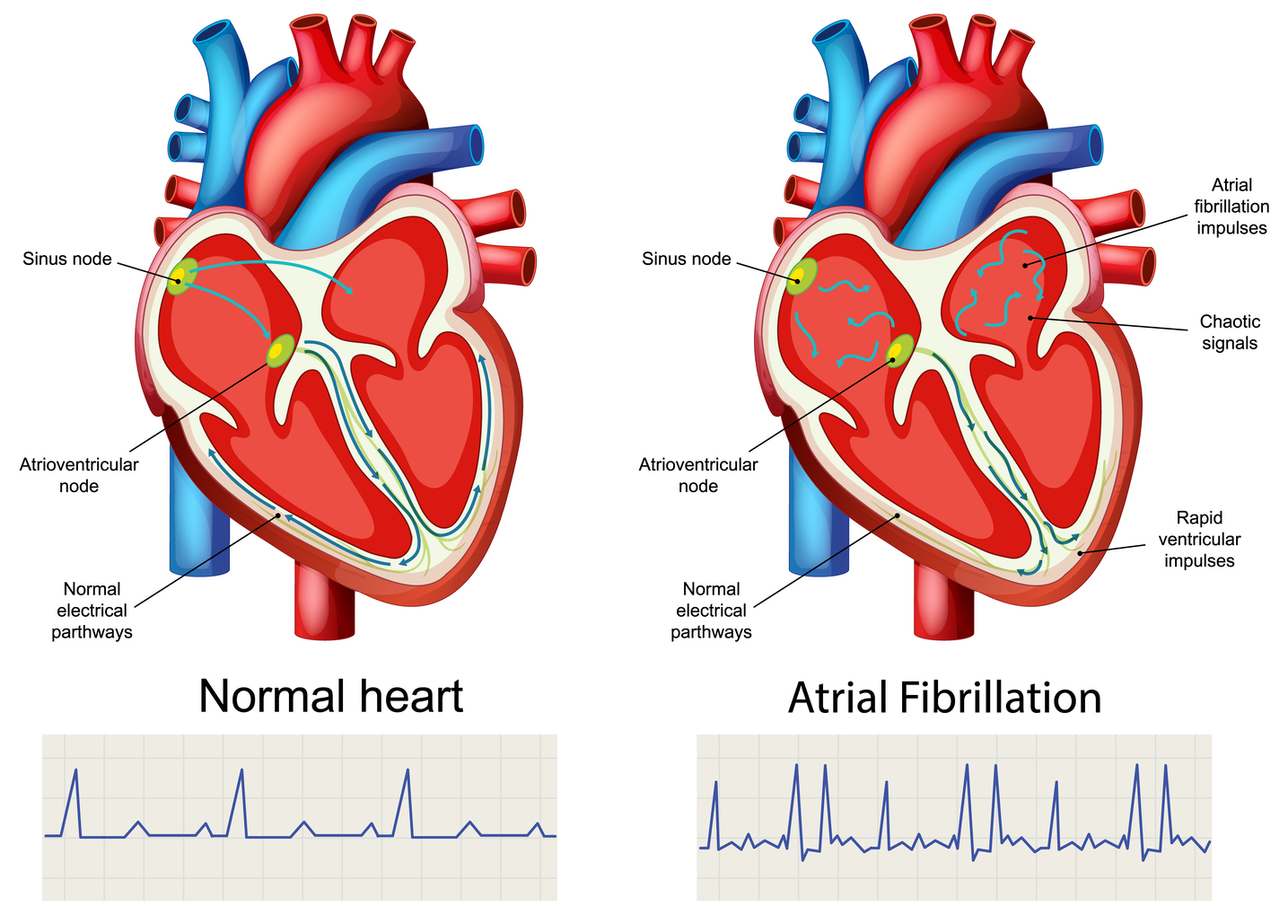 Ilustrasi Aritmia & Gangguan Irama
