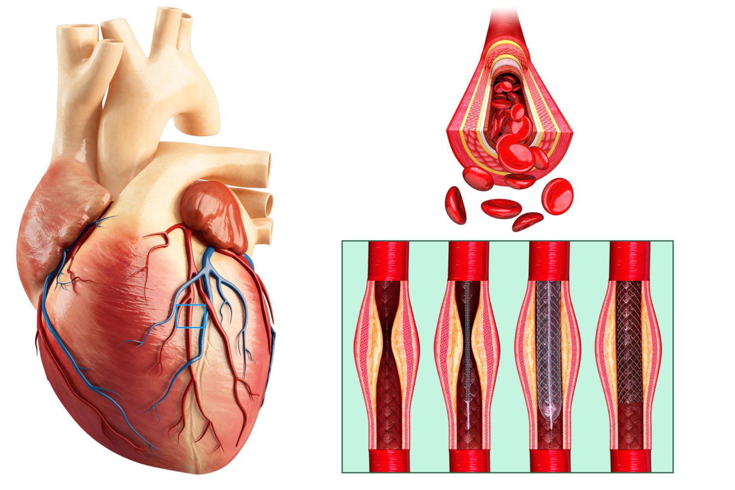 Operasi Bypass Jantung (CABG) di Malaysia