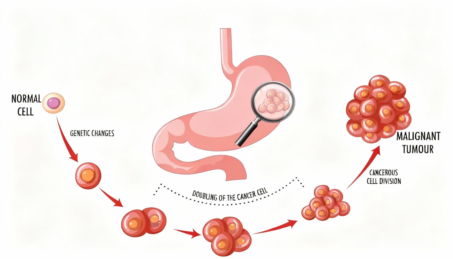 Kanker Lambung - OPSI Medis
