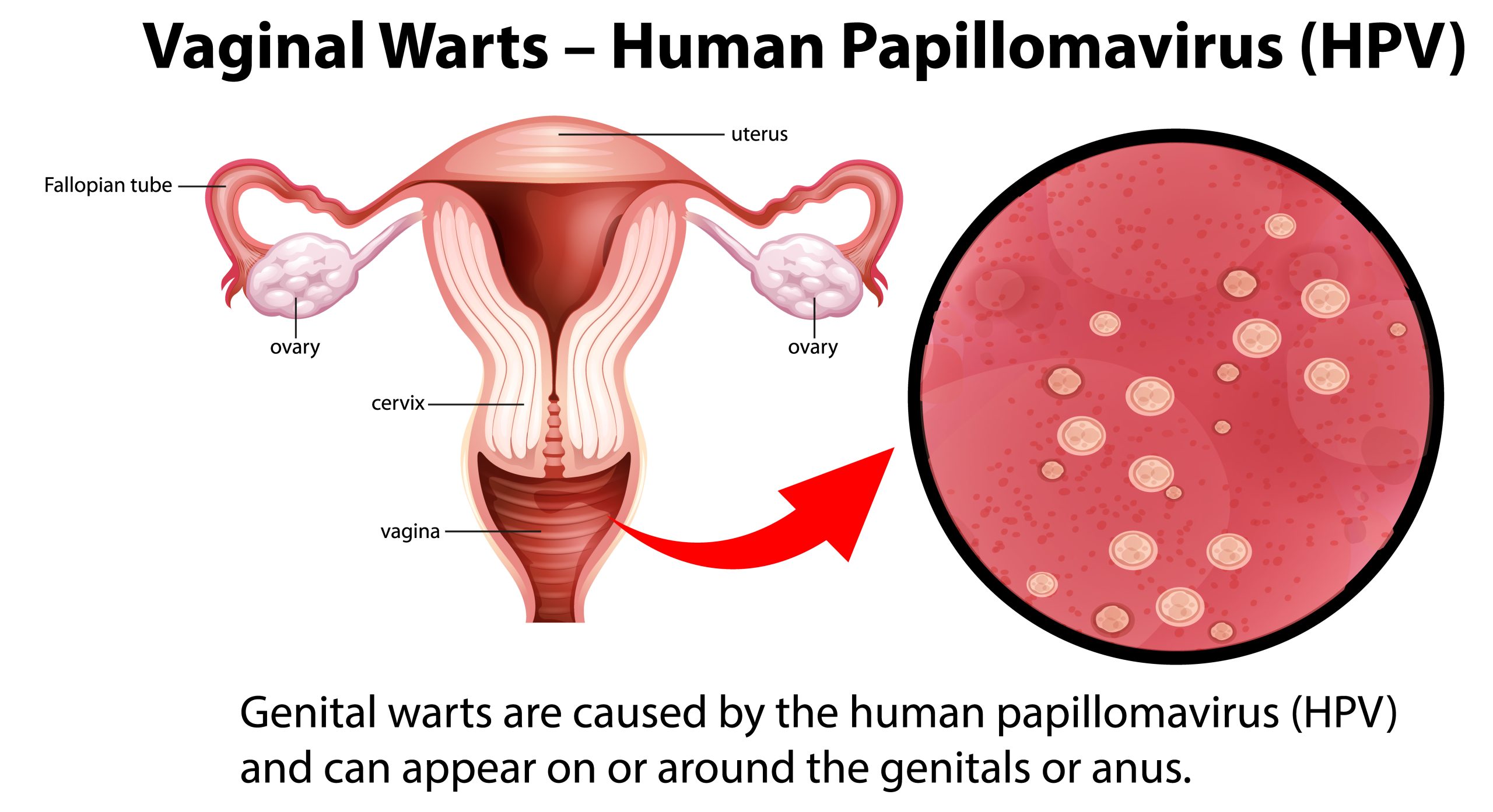 Vaksin HPV dan Pencegahan Kanker Serviks - OPSI Medis