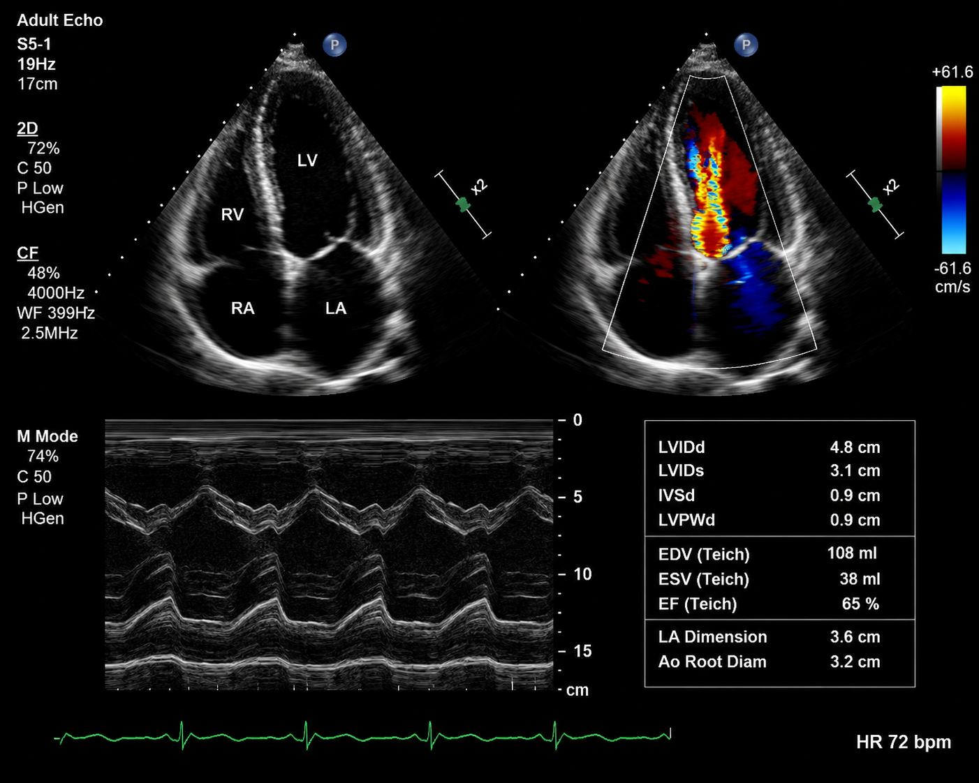 Contoh hasil echo jantung — tampilan echocardiogram dengan Ejection Fraction dan penilaian katup